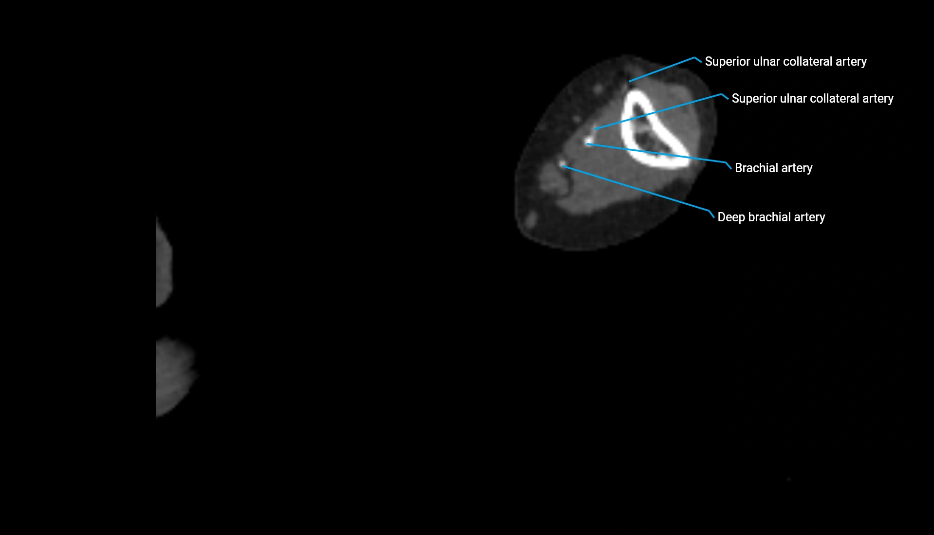 CTA upper limb axial cross sectional anatomy labelled image 203 (2).webp